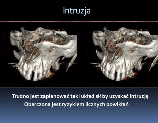 Powstrzymują wędrujące zęby (Zobacz) - 
