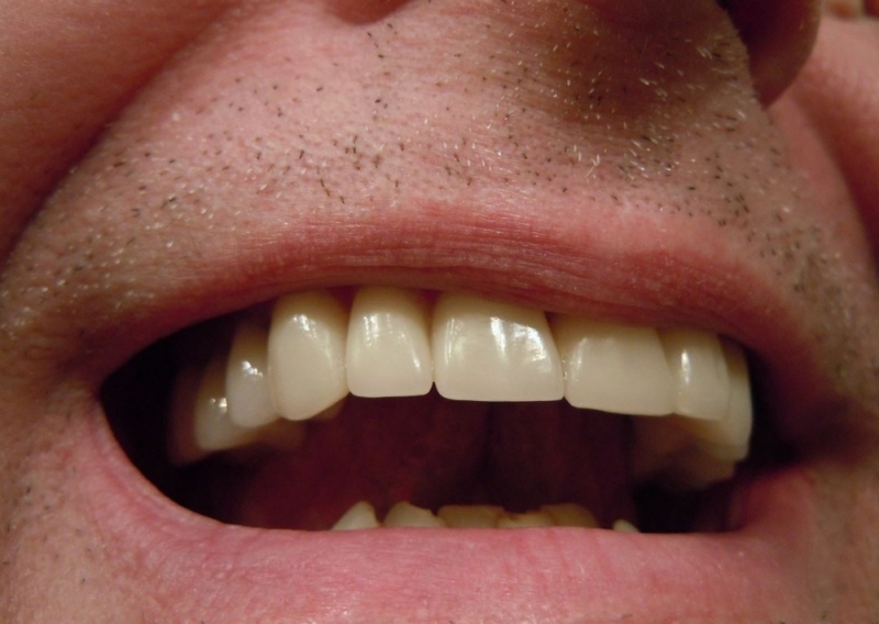 ROR: Dlaczego w nocy zgrzytamy zębami? (POSŁUCHAJ) - zdjęcie ilustracyjne (fot. Pixabay)