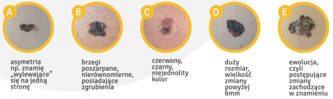 X Ogólnopolski Tydzień Świadomości Czerniaka - 1