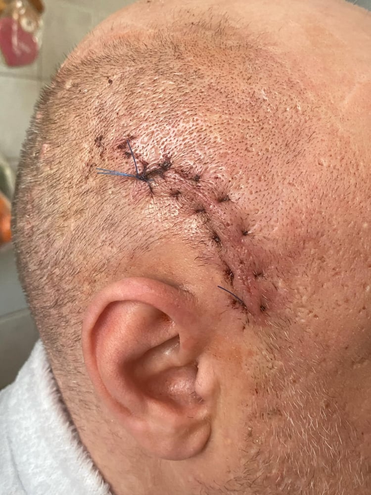 Nie chciał dać papierosa grupie nastolatków, którzy później brutalnie go pobili. Policja szuka świadków ataku - Poszkodowany po przeprowadzonej przez lekarzy operacji, która uratowała jego życie. Fot. Norbert Ziemlicki