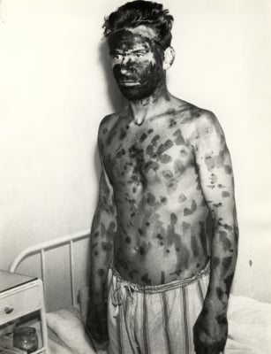 "Nie wracałam do domu, bo się bałam". 62. rocznica epidemii czarnej ospy we Wrocławiu [ARCHIWALNE ZDJĘCIA] - 11