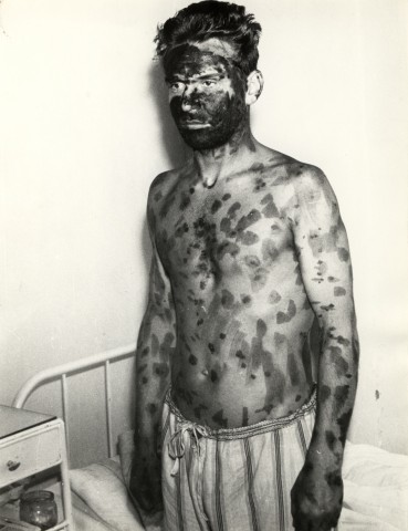 Z ARCHIWUM: Epidemia ospy we Wrocławiu (UNIKATOWE ZDJĘCIA) - 7