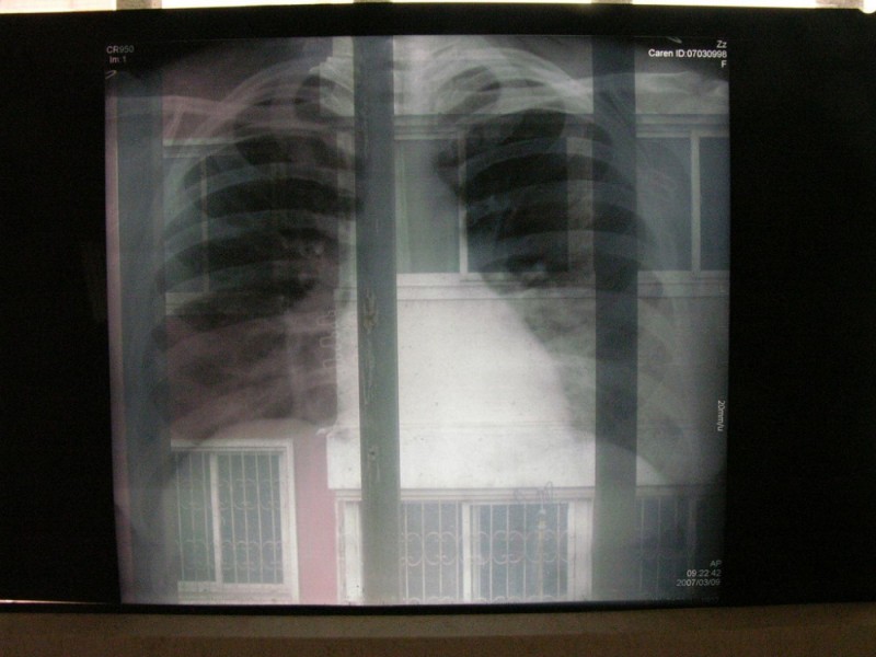 Niespełna połowa Dolnoślązaków słyszała o tej chrobie płuc - Caren / Flickr / CC BY-NC-ND 2.0